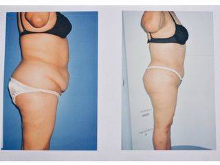 Antes y después de abdominoplastia