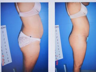 Antes y después de abdominoplastia