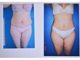 Antes y después de abdominoplastia