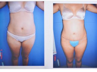 Antes y después de abdominoplastia