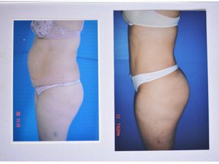 Antes y después de abdominoplastia