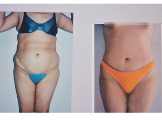 Antes y después de abdominoplastia