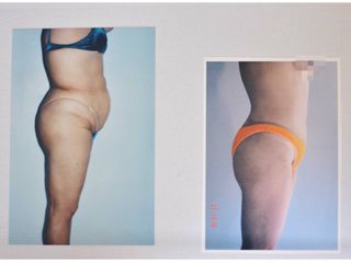Antes y después de abdominoplastia