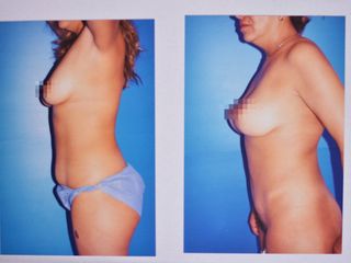 Antes y después de abdominoplastia y aumento de mamas