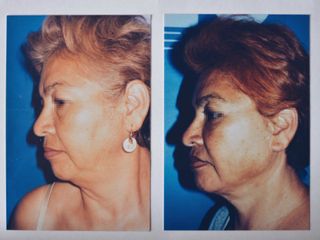 Antes y después de Rinoplastia