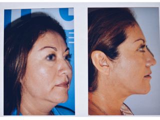 Antes y después de Rinoplastia