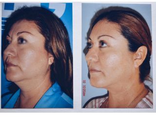 Antes y después de Rinoplastia