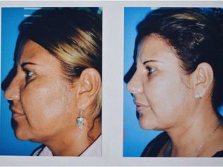 Antes y después de Rinoplastia