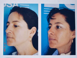 Antes y después de Rinoplastia