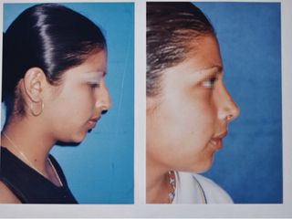 Antes y después de Rinoplastia