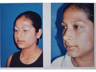 Antes y después de Rinoplastia