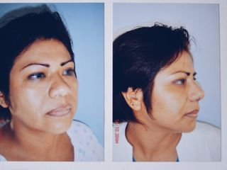 Antes y después de Rinoplastia