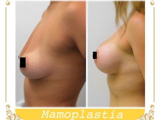 Antes y después de mamoplastia
