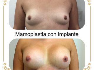 Antes y después de mamoplastia