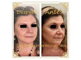 Antes y después de Rejuvenecimiento facial con Hilos. Colocación de hilos tensores reabsorbibles