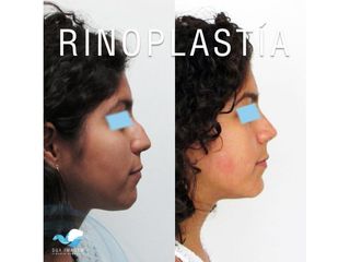 Antes y después de Rinoplastia
