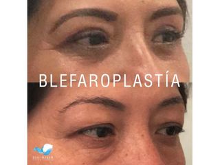 Antes y después de Blefaroplastia