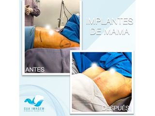 Antes y después de Aumento de busto
