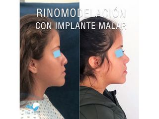 Antes y después de Rinomodelación con implante malar