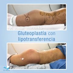 Antes y después de Gluteoplastia