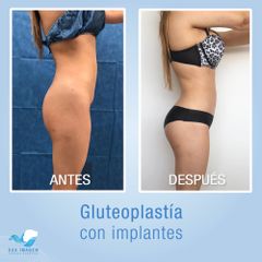 Antes y después de Gluteoplastia