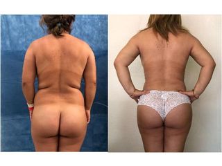 Antes y después de Liposucción