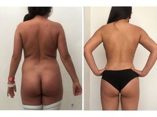 Antes y después de Liposucción