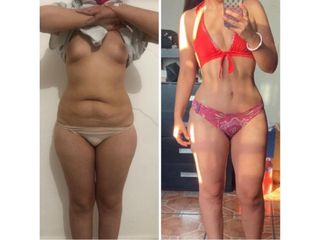 Antes y después de Liposucción