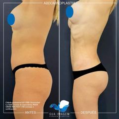 Abdominoplastia - Dr. Mario Alonso Flores Saldivar