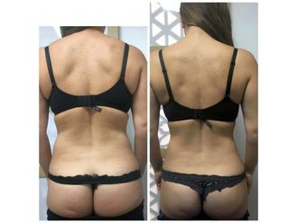 Carboxiterapia antes y después - 641794