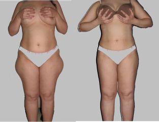 Antes y después de Lipoescultura