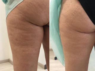 Antes y después de Tratamientos anticelulíticos