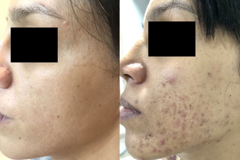 Tratamiento antiacné antes y después - 643867