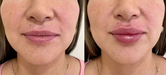 Antes y después de Aumento de labios