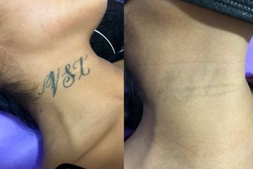 Antes y después de Eliminación de tatuajes 