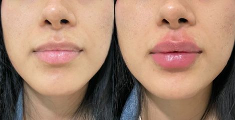 Antes y después de Aumento de labios