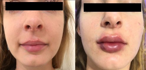 Antes y después de Aumento de labios