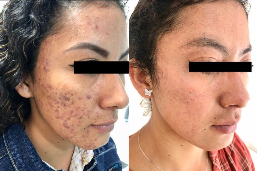 Tratamiento antiacné antes y después - 798299