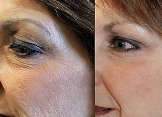 Antes y después de Rejuvenecimiento Facial