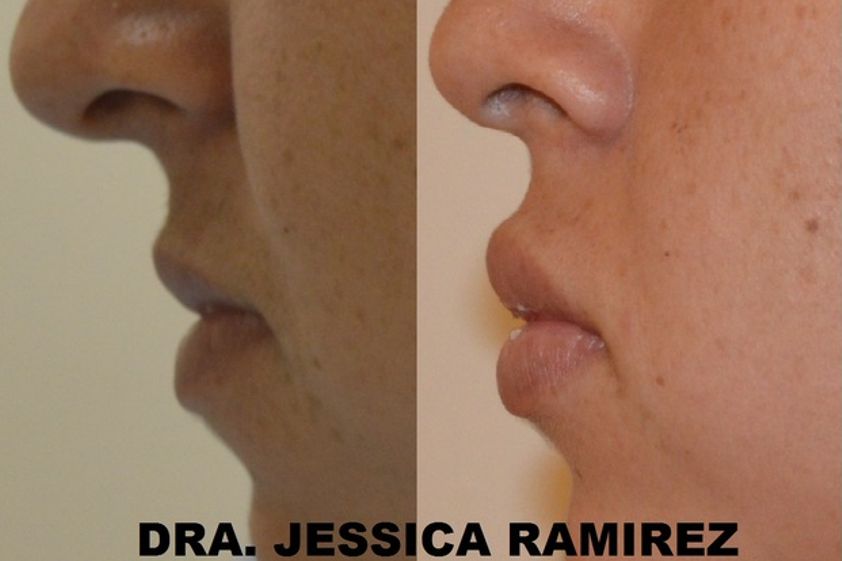 Aumento de labios antes y después - 544667