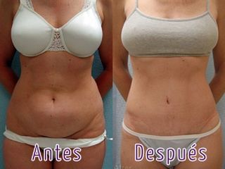 Antes y después de Abdominoplastia
