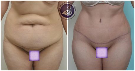 Antes y después de Abdominoplastia