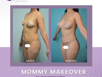 Mommy makeover - 865155