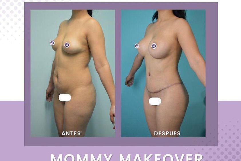 Mommy makeover antes y después - 865155