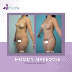 Mommy makeover - Dra. Jessica Ramírez Cadena