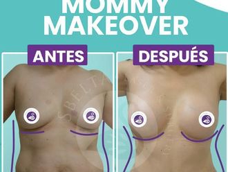 Mommy makeover - 865156
