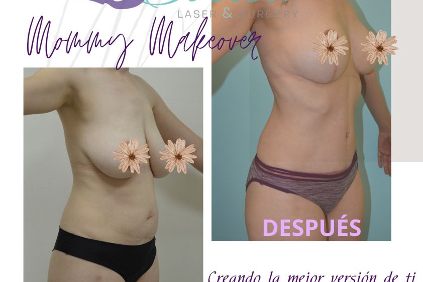 Mommy makeover antes y después - 865536