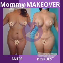 Mommy makeover - Dra. Jessica Ramírez Cadena