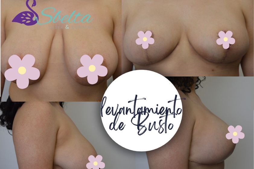 Mastopexia antes y después - 870387