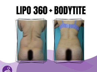 Lipoescultura antes y después - 870624